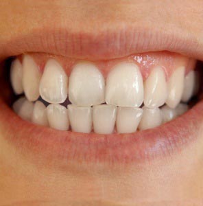 Final picture how to whiten teeth in photoshop